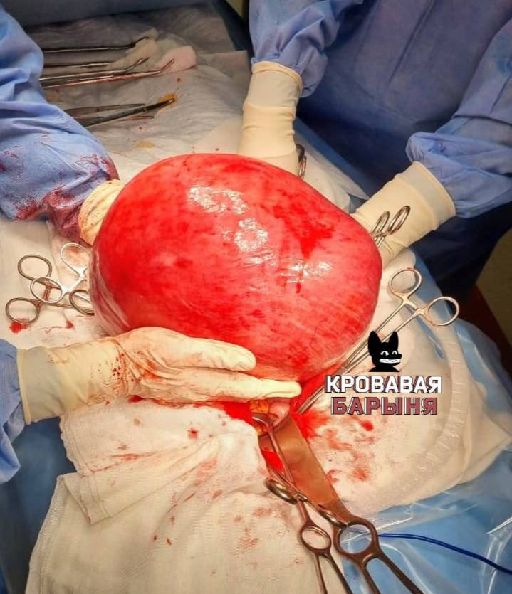 Не открывай если завтракаешь во Владивостоке врачи удалили гигантскую миому весом 15 кг Во Владивостоке врачи прооперировали 60 летнюю женщину с миомой матки размером более 30 недель беременности Опухоль весила около 15 килограммов сопоставимо с весом годовалого ребёнка Пациентка несколько лет терпела боли давление внизу живота и проблемы с мочеиспусканием но к медикам не обращалась Со временем состояние ухудшилось появились отёки затруднённое дыхание и ощущение неполного опорожнения мочевого пузыря За помощью она обратилась только тогда когда боль стала невыносимой и пришлось вызывать скорую В Тысячекоечной больнице женщину экстренно госпитализировали и провели сложную операцию осложнённую сдавлением внутренних органов Такие образования не вырастают за короткий срок это результат многолетнего игнорирования симптомов отметил заведующий гинекологическим отделением Эдуард Зиганшин Операция прошла успешно пациентка быстро пошла на восстановление а врачи вновь напомнили о важности регулярных осмотров и диспансеризации Подписаться прислать новость