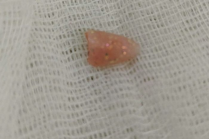 На Урале врачи достали из дыхательных путей 10 месячного малыша нарощенный ноготь В Челябинске врачи в ходе сложной операции извлекли из дыхательных путей 10 месячного ребенка инородное тело которым оказался нарощенный ноготь Ребенок с сильно затрудненным дыханием был экстренно доставлен в Челябинскую ОДКБ сообщается на странице медучреждения во ВКонтакте Поступил ребёнок плохо дышит дыхание жесткое с хрипами Мама рассказала что ребенок мог подавиться собачьим кормом Это было явно что то крупное что мешало ему вдохнуть рассказала в соцсетях ЧОДКБ эндоскопист Наталья Борисовна Степанова Врачи увидели в голосовой щели инородное тело закрывший ее просвет на 4 5 Визуально и по тактильным ощущениям это был плотный твёрдый объект похожий на кость говорится в сообщении ЧОДКБ Ребенок мог вдохнуть воздух лишь через маленький свободный участок Одно неловкое движение и он бы погиб vkvideo id 95452540 456239470 sh 4 uralweb ru