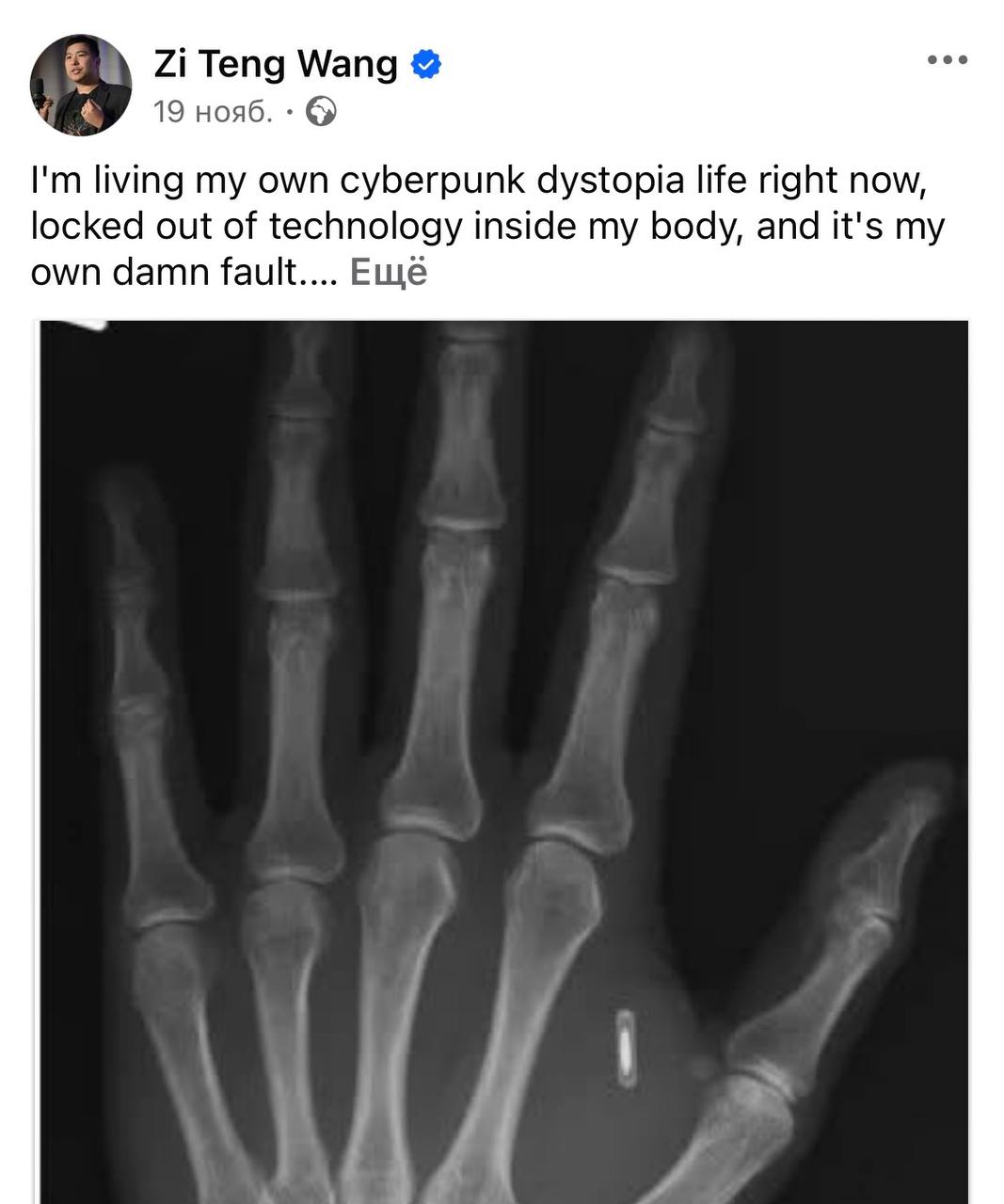 Проблемы будущего парень из США вживил себе чип в руку и забыл от него пароль Сначала он показывал фокусы с RFID чипом а потом решил записать на него сайт с мемами Когда ссылка перестала работать и он захотел поставить что то полезное его ждал сюрприз Сейчас я живу в киберпанковой антиутопии отрезанный от технологий внутри моего тела и это чёрт возьми моя собственная вина Жаль этого добряка