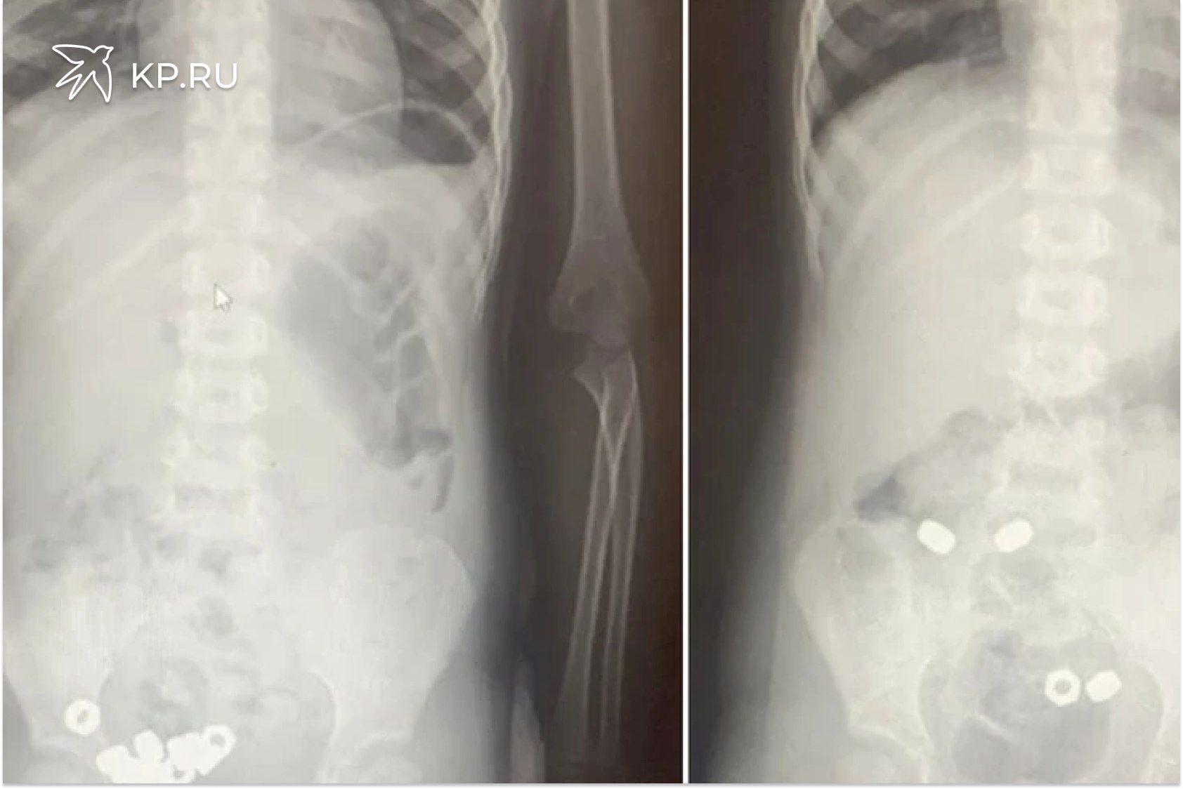 В Воронеже трехлетний малыш проглотил 16 гаек У 3 летнего ребенка воронежские врачи обнаружили в животе 16 гаек Малыша привели на прием в областную детскую больницу 2 родители предположили что мальчик проглотил инородные предметы Хотя никаких болезненных симптомов не испытывал Рентген брюшной полости действительно показал наличие множественных темных пятен в желудочно кишечном тракте ребенка Малыша госпитализировали чтобы исключить риск осложнений Инородные тела были не магнитные поэтому врачи выбрали консервативную тактику назначили диету покой контроль стула и рентгенографию в динамике К третьему дню все инородные тела успешно вышли естественным путем Оказалось что ребенок проглотил 16 гаек Малыша уже выписали сообщили в ОДКБ 2