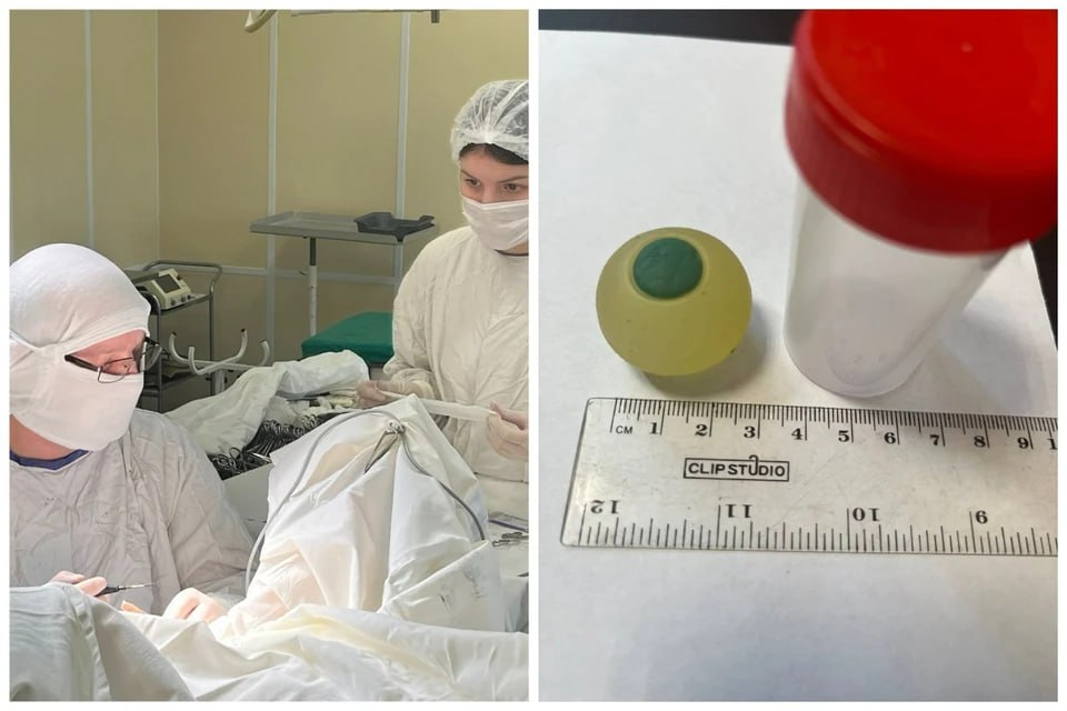 У меня такое впервые 9 летний мальчик проглотил силиконовый глаз и страдал от боли и тошноты но не признавался Тошнота рвота и сильные боли в животе мучали девятилетнего мальчика Врачи думали что это обычное отравление или инфекция но диагноз не подтверждался а ребенку становилось все хуже В одной из больниц города ему не смогли помочь и перенаправили в другую Но и там сначала не понимали что же случилось с мальчиком Сделали рентген но и он ничего не показал Только позже выяснилось что предмет который застрял в кишечнике оказался рентген отрицательным Зато УЗИ показало какой то лишний предмет в левом подреберье и непроходимость кишечника Но что же именно там находится было непонятно Как же удивились врачи когда во время операции вытащили силиконовый глаз Он путешествовал по организму он целых пять дней Но сам ребенок об этом врачам не рассказывал Мама уверена что все это случайность Уже после операции мы стали вспоминать с сыном что неделю назад он ел шуточные сладости мармеладные глаза Рядом с коробкой лежал и этот силиконовый Ребенок играл в игру на телефоне и видимо не глядя проглотил и этот предполагает мама мальчика   Подписаться на chelkp