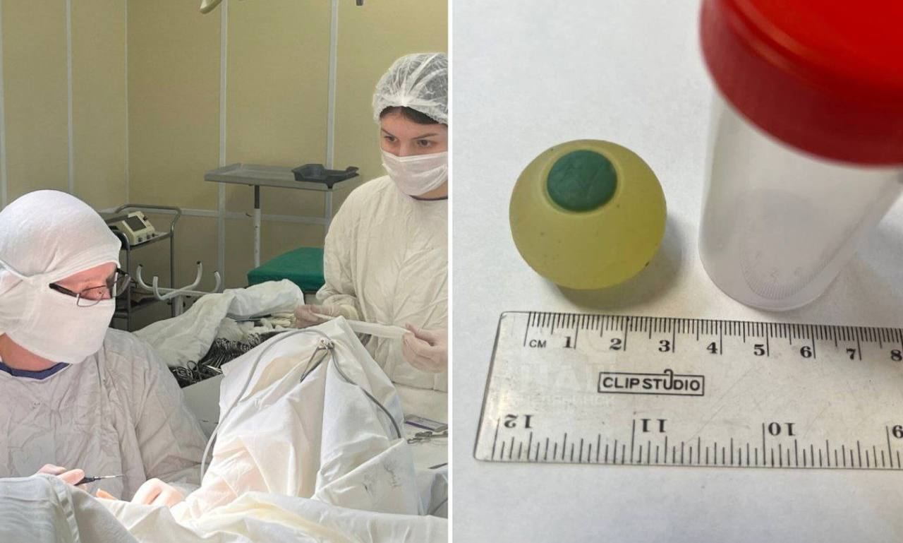 Извлекли из кишечника мальчика силиконовый глаз Необычный случай произошёл в ГКБ 1 9 летнего ребёнка доставили с подозрением на отравление у него были боли в животе тошнота и рвота Обследование показало кишечную непроходимость Как выяснилось во время операции причиной стал силиконовый глаз элемент от игрушки проглоченный ребёнком несколько дней назад Мальчик не помнил об этом из за чего диагностика осложнилась Операция прошла успешно предмет удалось убрать