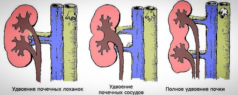 Нижегородец и не знал, что живет с аномальными двойными почками   Пациент поступил в урологическое отделение НОКБ им.Н.А.Семашко с жалобами на камни в почках и мочеточнике. По результатам УЗИ диагноз был вполне ожидаемым, МСКТ почек с контрастом сделать не смогли – у пациента непереносимость препарата.   А вот в операционной урологов уже ждал сюрприз  На уретроскопии обнаружили полное удвоение и почек, и мочеточников с обеих сторон. Пациент – хронический камневыделитель, но о своей аномалии узнал впервые.   Камень успешно удалён, уже на третьи сутки пациент выписан домой.  «Полное удвоение почек – это наличие двух чашечно-лоханочных систем, двух мочеточников, открывающихся двумя устьями в мочевом пузыре.  Удвоенная почка крупнее обычных, может никак себя не проявлять и обнаруживается случайно», — сообщил врач-уролог НОКБ, к.м.н. Василий Власов.    По словам врачей, одновременное удвоение почечной лоханки и мочеточников часто вызывает нарушение уродинамики, повышая риски хронического воспаления.