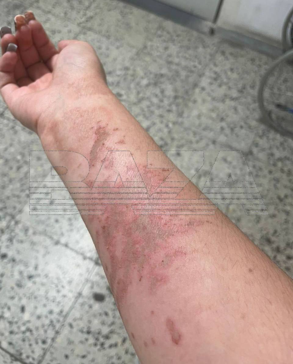 На сельхозпредприятии в Ленобласти девушку обожгло серной кислотой На СПК «Кобраловский» при анализе молока бригадир получила химические ожоги лица и тела. По предварительным данным, кислота под давлением вырвалась из закрытого дозатора. Пострадавшую экстренно госпитализировали: сначала в реанимацию, затем перевели в хирургию. Сейчас ей предстоит длительное восстановление. На предприятии организована проверка техники безопасности и причин ЧП. Флэш Питер - подписаться