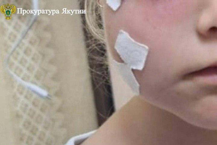 70 тысяч за испуг и раны В Нерюнгри бродячая собака напала на маленькую трехлетнюю девочку оставив ей рану от зубов на щеке По версии прокуратуры виной тому стала халатность городских властей которые плохо исполняют свои обязанности по отлову безнадзорных животных Прокуратура подала иск в суд чтобы защитить права пострадавшего ребенка Фемида полностью согласилась с доводами ведомства и постановила взыскать с администрации Нерюнгри компенсацию морального вреда в размере 70 тысяч рублей в пользу девочки Исполнение судебного решения сейчас находится на контроле прокуратуры Фото прокуратура Якутии