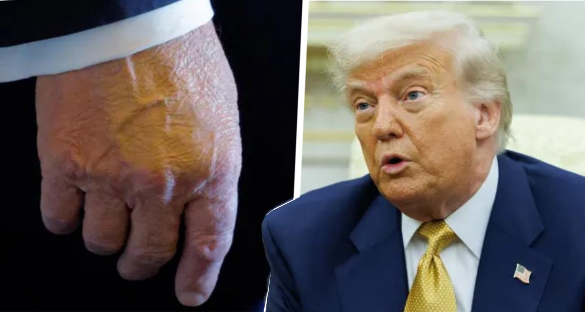 Врачи диагностировали у Трампа хроническое заболевание вен, заметив отёки на ногах и синяки на руках В четверг Белый дом сообщил о диагностировании у 79-летнего президента США хронической венозной недостаточности. По словам пресс-секретаря Белого дома Каролины Ливитт, президент прошёл медицинское обс...  Ссылка на новость: