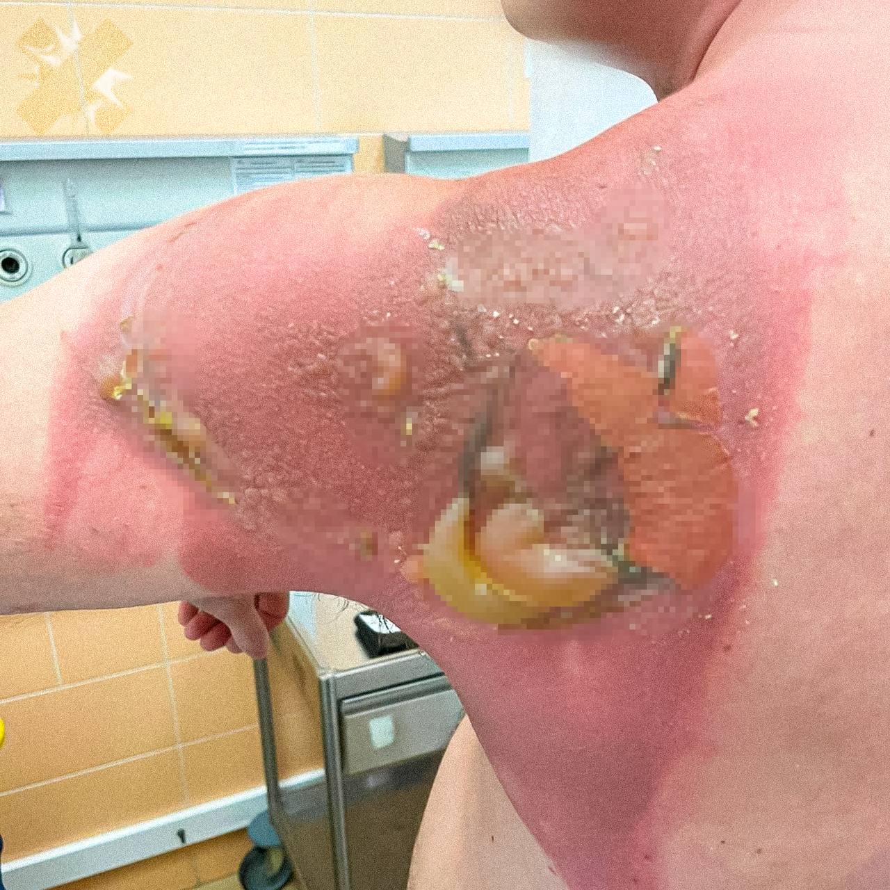 Парень из Татарстана получил сильнейшие ожоги после сна на чистом белье 26 летний мужчина проснулся от резкого жжения в спине кожа стала багровой и покрылась крупными волдырями В больнице диагностировали химический ожог 1 2 степени Причина новые азиатские капсулы для стирки которые попробовала его супруга По словам врачей в них могла быть слишком высокая концентрация ПАВ Остатки вещества впитались в ткань постельного белья и за ночь буквально прожгли кожу Будьте аккуратны с непроверенной бытовой химией азиатские капсулы больше не берём здоровья мужчине НМШ