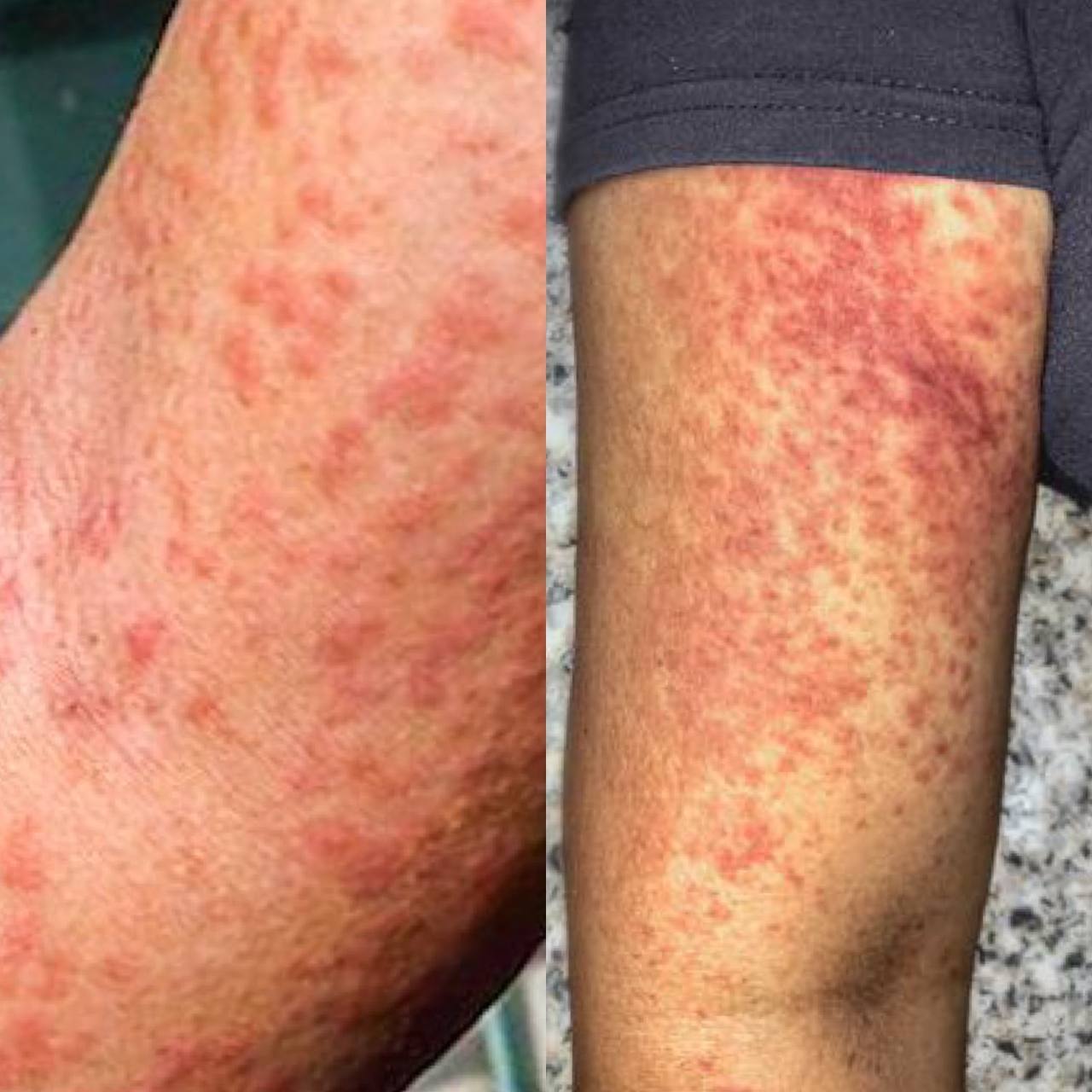 В Россию завезли лихорадку чикунгунья В России зарегистрировали завозной случай лихорадки чикунгунья заболевшая прилетела в Москву после отдыха на Сейшельских островах Об этом сообщили в Роспотребнадзоре подчеркнув что риск распространения инфекции внутри страны минимален Вирус не передаётся от человека к человеку и распространяется только через укусы инфицированных комаров В ведомстве заявили что все необходимые противоэпидемические меры были оперативно организованы На фоне этого сообщения внимание привлекает ситуация в Китае где вирус распространяется значительно активнее Там уже заболели более 7 тысяч человек Только за последнюю неделю зафиксировано около 3 тысяч новых случаев как минимум в 12 городах Власти КНР вводят меры сравнимые с периодом пандемии COVID 19 Лихорадка чикунгунья сопровождается высокой температурой и сильными болями в суставах Подписаться прислать новость