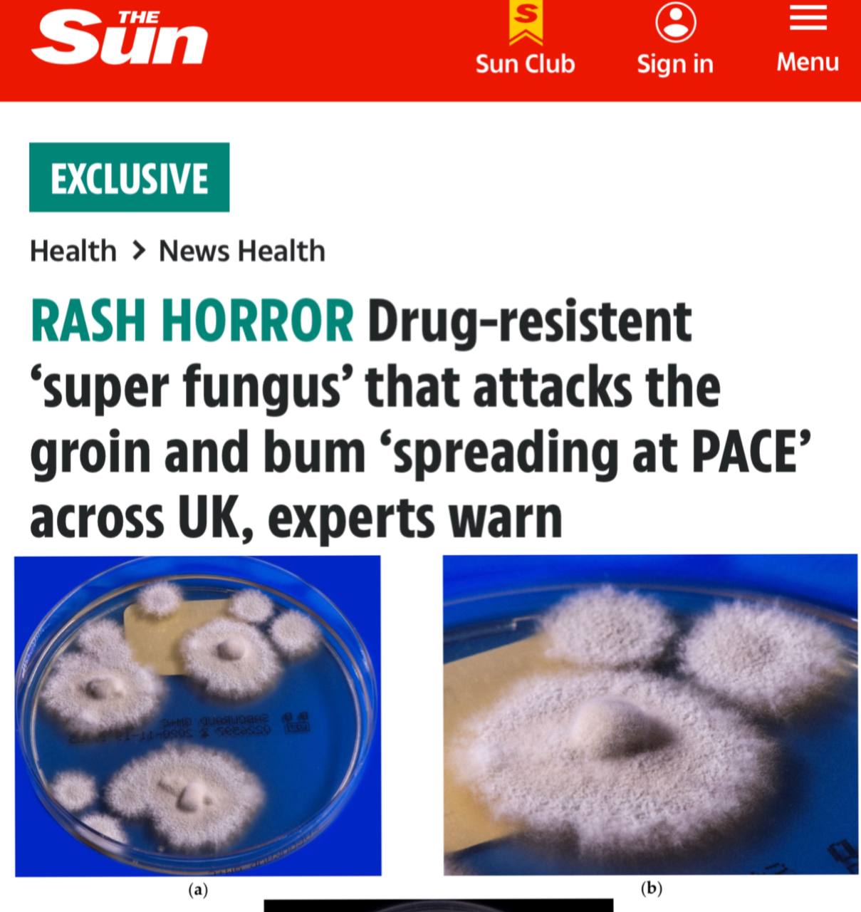 В Европе распространяется опасный супергрибок По данным The Sun его название Trichophyton indotineae Инфекция вызывает красные зудящие высыпания в основном в паху на бедрах и ягодицах За последние три года число случаев заражения увеличилось почти на 500 Trichophyton indotineae передается как путем прямого контакта с больным человеком так и через грязные поверхности Заболевание не опасно для жизни но его очень трудно лечить и больным приходится проходить курсы терапии по нескольку недель или даже месяцев Инфекция уже активно передается по территории Британии Франции и Германии а также зафиксированы случаи заражения в США По словам эксперта по инфекционным заболеваниям Манчестерского университета Дэвида Деннинга это станет большой проблемой во всем мире Подписаться на URA RU мы в MAX