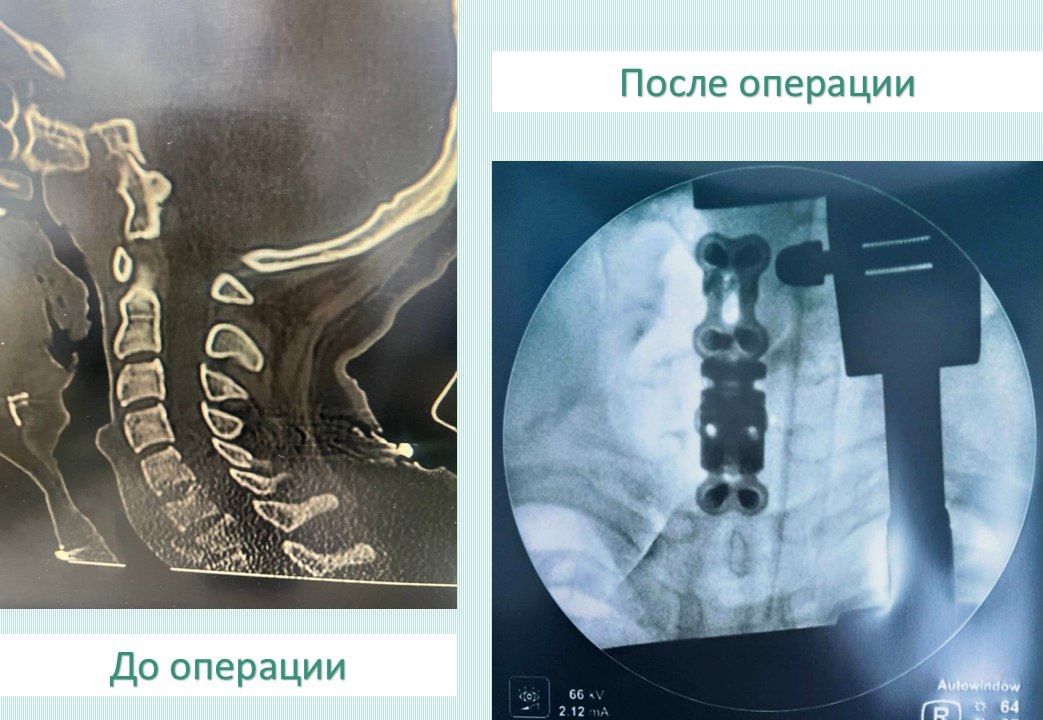 Врачи Центра травматологии, ортопедии и нейрохирургии спасли 17-летнего юношу, поступившего в больницу с тяжелыми травмами позвоночника и таза после падения с высоты. Несмотря на неблагоприятный прогноз, подросток начал восстанавливать подвижность. Пациенту провели сложные операции: заменили разрушенные шейные позвонки на титановые конструкции и устранили вывих бедра. Через 10 дней — еще одну операцию на тазовых костях. К моменту выписки чувствительность и двигательные функции продолжали улучшаться. — Спинной мозг был серьезно поврежден, поэтому прогноз был неблагоприятный, однако, благодаря своевременности и полноте проведенного лечения, мы добились восстановления движений у пациента, – пояснил Сергей Кошкин, — пояснил нейрохирург Сергей Кошкин.