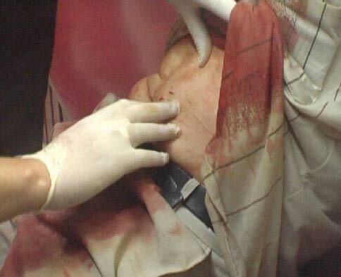 Кировчанка пырнула ножом мужа в его День рождения Супруги отмечали праздник выпивали и поссорились После чего мужчина ушел из дома а когда вернулся не смог попасть домой Жена заперлась изнутри опасаясь агрессивного поведения супруга После того как мужчине удалось попасть в квартиру жена схватила нож и нанесла ему удар в область живота Прибывшие на место медики оказали помощь пострадавшему По данному факту возбуждено уголовное дело по статье Умышленное причинение тяжкого вреда здоровью Подписаться