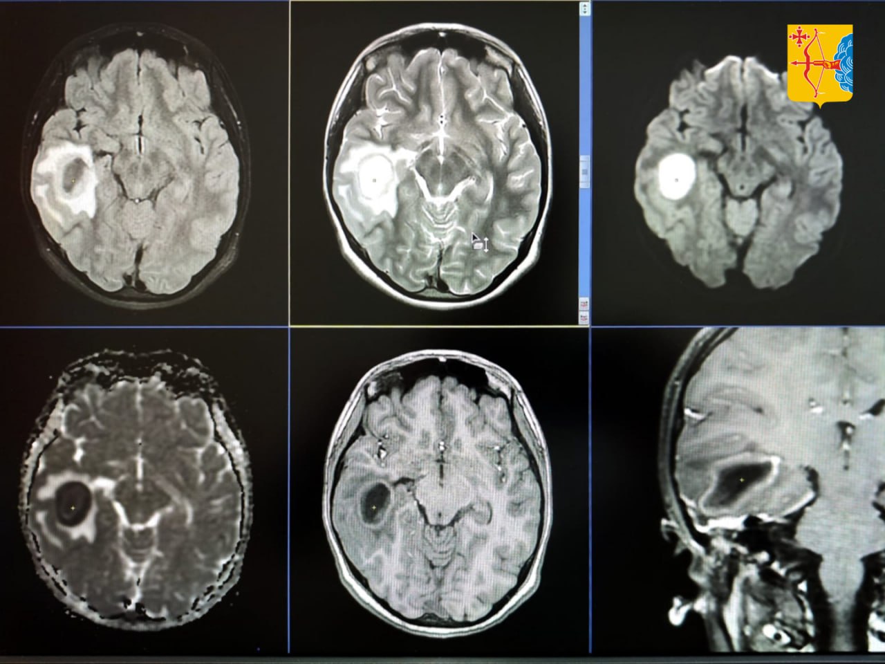 Кировские врачи спасли жизнь 13-летней девочки с абсцессом мозга.  Ребенок обратился в больницу с жалобами на боль в ушах. Назначенное врачом лечение не помогло — через несколько дней у школьницы поднялась температура, появились боли в висках. С температурой 38,8 девочку госпитализировали в центральную районную больницу. Терапия антибиотиками также не принесла результата, ребенку становилось хуже.  Пациентку перевели в Кировскую детскую областную больницу. МРТ показало большой абсцесс непосредственно в веществе мозга, а также деструкцию костей внутреннего уха.  — Оториноларингологи совместно с нейрохирургом провели сложнейшую операцию, спасли жизнь девочки и сохранили ее здоровье. Сегодня юная пациентка приходит в Детскую областную больницу на периодические контрольные исследования МРТ, по которым видна положительная динамика, — рассказала главный врач Кировской областной детской клинической больницы Наталья Муратова.  Напомним, что с 2025 года Кировская область участвует в национальном проекте «Продолжительная и активная жизнь», который стал продолжением нацпроекта «Здравоохранение».   Кировская область