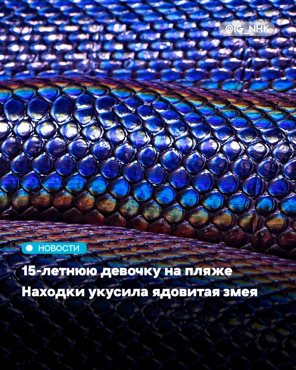 Поздним вечером на пляже 15-летнюю девушку укусила ядовитая змея. У подростка стремительно развилась тяжелая аллергическая реакция — анафилактический шок на змеиный яд. В состоянии спутанного сознания и с пониженным давлением, с нарастающим отеком конечности, пострадавшую экстренно доставили в больницу родители.  Врачебная помощь включала противошоковые мероприятия и дезинтоксикационную терапию. Ключевым было восстановление кровоснабжения в поврежденной ноге для предотвращения омертвения тканей. Хотя сильный отек создавал риск, требующий потенциального рассечения конечности  фасциотомии , медицинской команде удалось стабилизировать состояние без хирургического вмешательства.  После устранения угрозы для жизни пациентка была переведена на амбулаторное долечивание под наблюдением поликлиники.