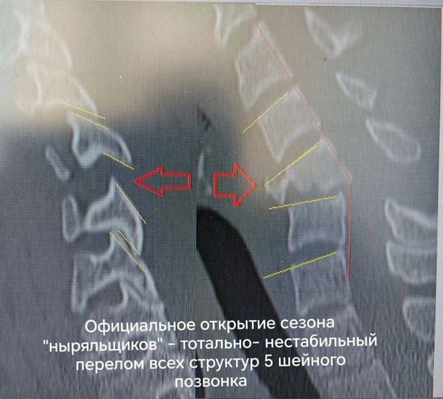 В Красноярске трое мужчин сломали шейные позвонки на отдыхе Двое травмировались в бассейне, когда ныряли в воду. Третий мужчина получил перелом во время падения с турника на землю. В БСМП отметили, что им повезло, задеты были только кости, спинной мозг не повредили. Также пострадавшим установили в позвоночник металлоконструкции, теперь им предстоит реабилитация. Фото: Минздрав Коасноярского края