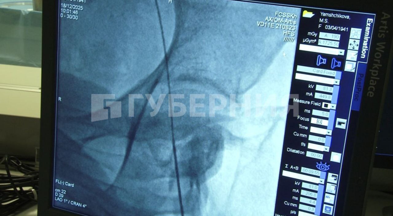 Хабаровские хирурги применяют новую технологию при операциях на сердце Она позволяет снизить риск инсультов после подобных вмешательств что особенно актуально для возрастных пациентов Во время операции хирурги вводят катетер который содержит в себе две ловушки Они позволяют частично перекрывать кровоток по артериям мозга Таким образом объясняют специалисты операция становится более безопасной То есть фильтруется та часть которая потенциально может вызывать инсульты и слабоумие так называемую деменцию Это мелкие частицы которые ловушка позволяет задержать во время операции не давая проникнуть в головной мозг и нарушить его питание рассказал заведующий отделением рентген хирургии федерального центра сердечно сосудистой хирургии Хабаровска Константин Поляков Обучение этому методу ведущие хирурги страны проходили за рубежом и поделились опытом со специалистами хабаровского сердечно сосудистого центра С использованием новой технологии уже прооперировано более 60 пациентов Самому пожилому из них 92 года В дальнейшем эту программу планируют развивать