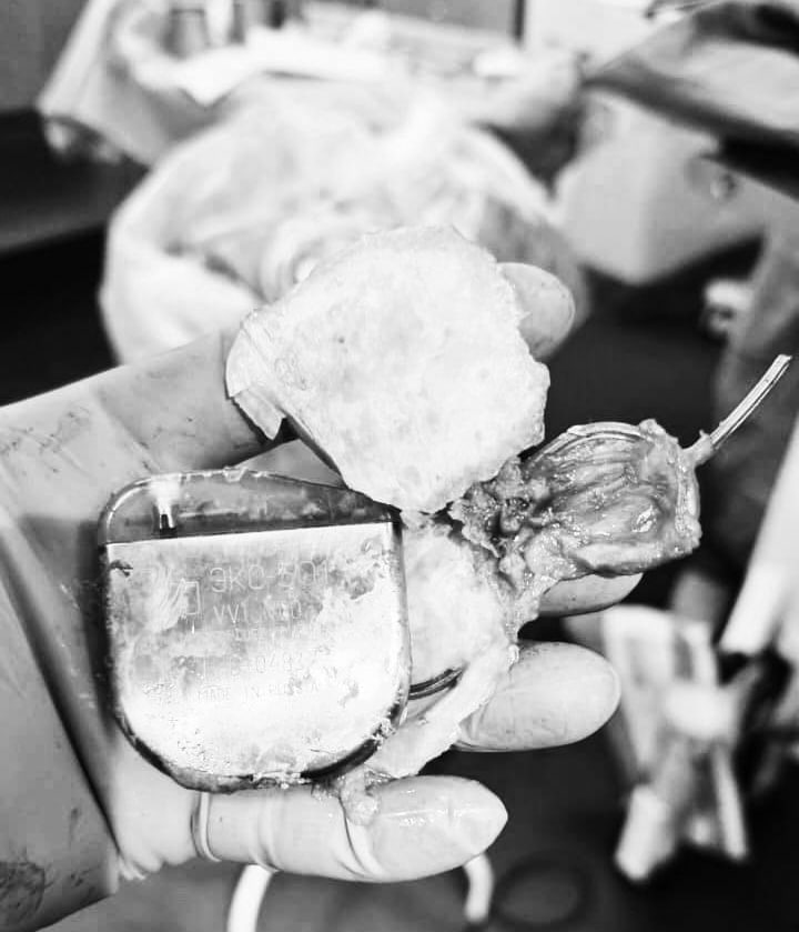 В Татарстане врачи спасли женщину кардиостимулятор которой врос в тело Обычно устройство меняют максимум через 10 лет с момента установки но 80 летняя жительница Татарстана проходила с ним с 1993 года Удаление старого кардиостимулятора для хирургов стало настоящим испытанием он успел закальцинироваться и врасти в тело Мы столкнулись с подобным случаем впервые были очень удивлены Еще более удивительно в этой истории то что кардиостимулятор исправно работал на протяжении долгих лет Вечерка в MAX в Telegram