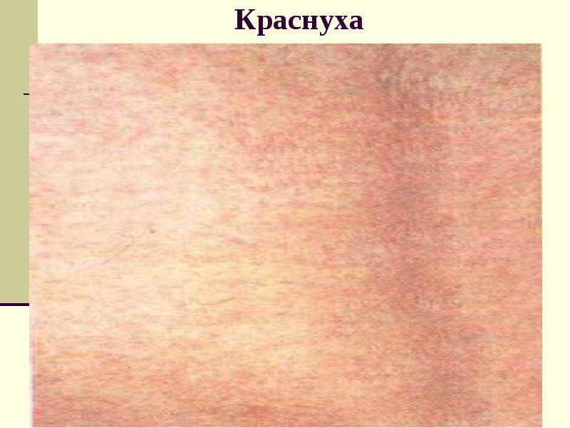 Первый за 15 лет случай заражения краснухой выявлен в Адыгее. «С 2010 г. в республике не регистрировались случаи краснухи, однако за пять месяцев 2025 г. зарегистрирован один завозной случай у жителя Чеченской Республики», – сказала Зезарахова. Среди местного населения заболеваемость отсутствует благодаря высокому уровню вакцинации.