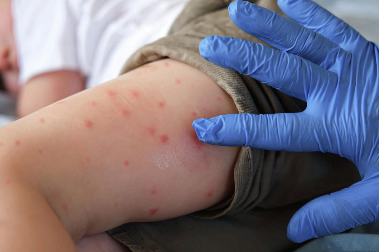 В Москве выявили случай лихорадки чикунгунья Заболевшая прибыла в столицу после отдыха на Сейшельских островах где неоднократно подвергалась укусам комаров Сразу после прилёта её госпитализировали В Роспотребнадзоре заявили что риска масштабной вспышки нет Чикунгунья передаётся исключительно через укусы инфицированных комаров