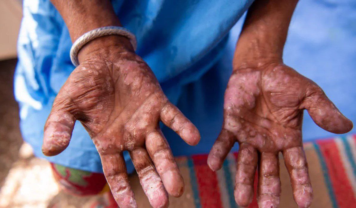 Случай лепры в Клуж Напоке Румыния три массажистки из Азии под медицинским наблюдением В Клуж Напоке Румыния подтверждён один случай лепры ещё три подозрительных случая у женщин из Азии работающих массажистками в SPA салоне находятся на клиническом и эпидемиологическом контроле Салон временно закрыт проводится дезинфекция и проверка всех помещений а сотрудники проходят медицинский осмотр Министерство здравоохранения Румынии сообщает что после начала лечения риск передачи болезни исчезает а угрозы для населения нет Подписаться