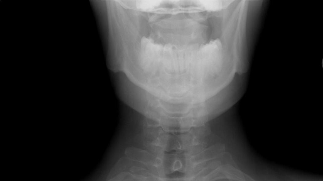 В Челябинске школьница сломала три позвонка на уроке физкультуры В одной из школ Челябинска произошло ЧП на уроке физкультуры ученица 6 класса выполняя кувырки получила серьезную травму На уроке физкультуры на котором учитель демонстрировал технику выполнения кувырков девочка как и многие ее одноклассники демонстрировала свои навыки Однако после второй попытки выполнения упражнения она почувствовала резкую боль в области шеи Сразу после инцидента школьница была отправлена в медпункт где ей оказали первую помощь Однако состояние ребенка требовало более серьезного вмешательства и вскоре пострадавшую доставили в больницу Врачи провели обследование и выявили компрессионные переломы трех позвонков Это означает что 6 класснице предстоит долгий путь к восстановлению около полугода она будет вынуждена носить специальный корсет Мать пострадавшей девочки выразила недовольство действиям сотрудников школы Женщина утверждает что скорую помощь педагоги вызывать не спешили что могло усугубить состояние ребенка В учебном заведении где произошел инцидент началась внутренняя проверка