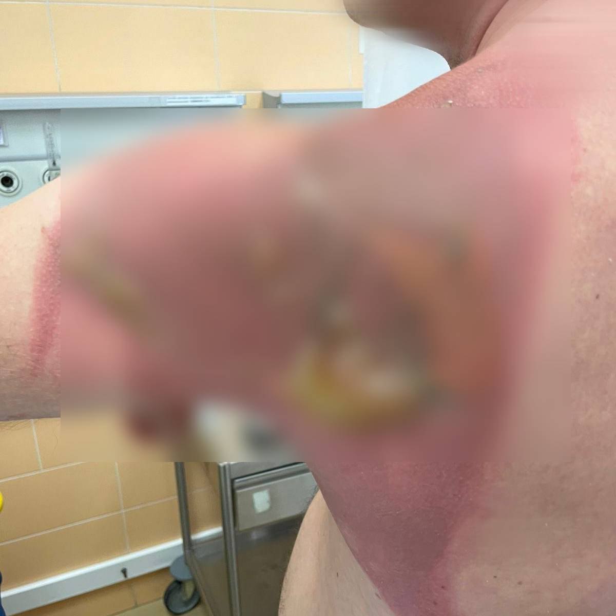 Житель Татарстана получил химический ожог после стирки с капсулами из Азии Со слов мужчины капсулы его супруга купила на маркетплейсе И постирала с ними постельное белье а после этого застелила им кровать На следующее утро молодой человек проснувшись обнаружил на своем теле химический ожог Ожоговый хирург РКБ Татарстана Айрат Шарипов диагностировал 26 летнему пациенту химический ожог 1 2 степени Рану обработали помощь оказали и отпустили домой рассказали в республиканской клинической больнице Наша РКБ Как в Волгу глядели