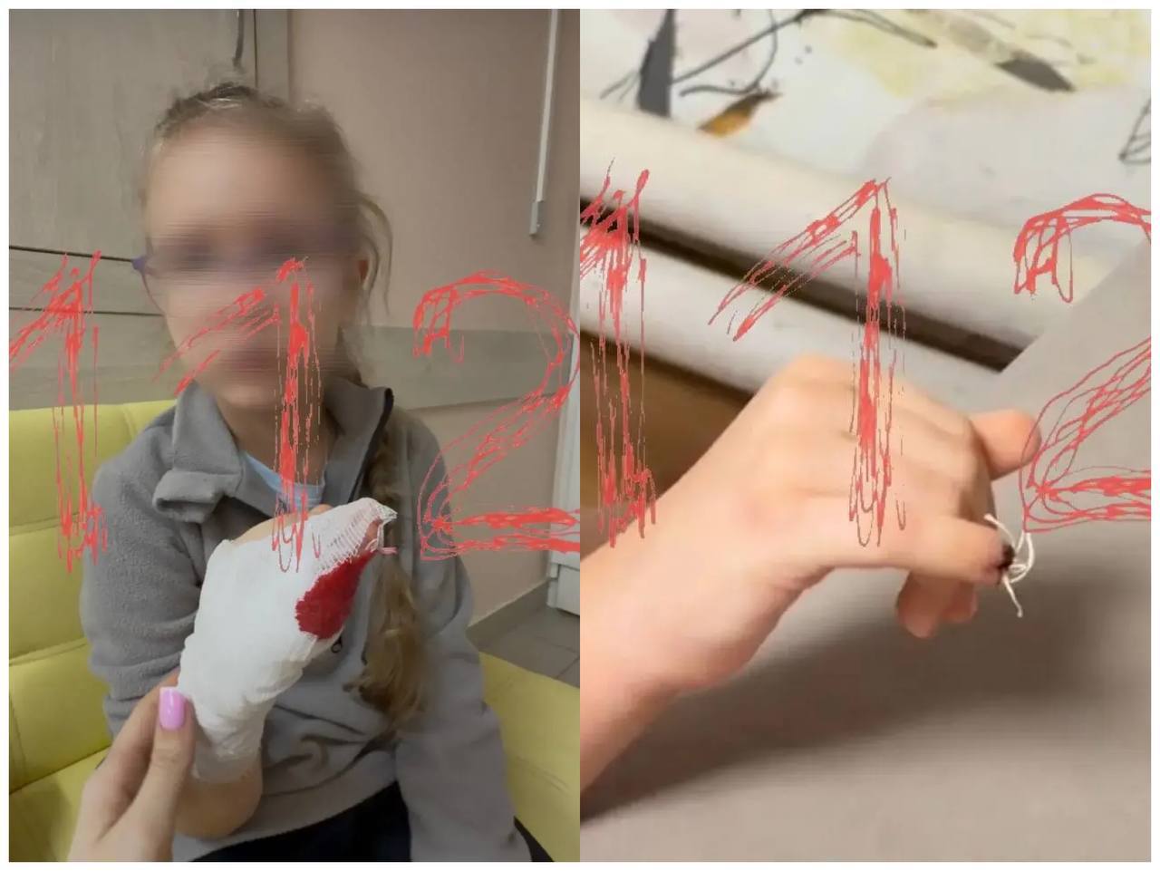 Барнаул 1 Ампутация может грозить девочке после травмы в бийском детсаду Во время похода на физкультуру девочке прищемили палец дверью спортзала В детсаду лишь меняли повязку и не вызвали скорую сославшись на отсутствие родителей Теперь семья ездит по больницам На данный момент у ребенка торчит косточка из пальца которую скорее всего невозможно будет спасти и будет дальнейшая ампутация пальчика добавила женщина Возбуждено уголовное дело Мы в МАХ Написать нам