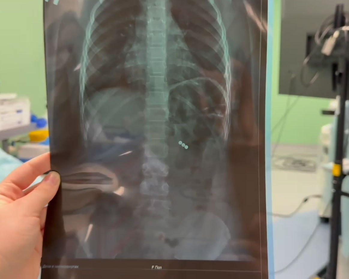 В Иркутскую областную детскую клиническую больницу поступила восьмилетняя девочка которая во время игры в школе случайно проглотила три магнитных шарика Ситуация была крайне опасной так как магниты притянулись друг к другу и вызвали перфорации в организме Иркутские хирурги выполнили экстренное малоинвазивное т е с минимальным проникновением в организм вмешательство и успешно удалили инородные предметы Девочка уже чувствует себя хорошо Об этом сообщил заслуженный врач России Юрий Козлов Сегодня самая большая проблема неодимовые магниты которые используются как компоненты детских игрушек Если проглатывание одиночного магнита не несет значительной угрозы для здоровья ребенка то проглатывание множественных магнитных инородных тел при притягивании их между собой оказывает силу до полукилограмма что может вызвать ишемию некроз и перфорацию стенок кишечника Родителям важно помнить что жизнь и здоровье детей находится в их руках отметил Юрий Козлов