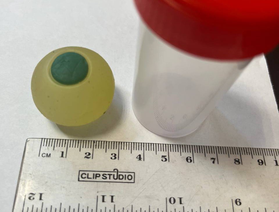 В Челябинске врачи достали из кишечника ребенка силиконовый глаз В Челябинске врачи Городской клинической больницы 1 извлекли из кишечника девятилетнего мальчика силиконовый глаз который путешествовал по организму ребенка пять дней Выявить его удалось не сразу из за материала игрушку не видел рентген Школьника доставили в ГКБ 1 из инфекционного стационара другой местной больницы куда он поступил с жалобами на тошноту рвоту и боль в животе Там медики заподозрили у него отравление или инфекционное заболевание Однако диагноз не подтвердился В ГКБ 1 ребенку провели рентген исследование которое показало кишечную непроходимость Однако с чем она была связана было неясно Это осложняло ситуацию Мы не увидели предмета который был причиной Позднее стало понятно что и не могли бы увидеть Предмет был рентген отрицательным пояснил заведующий детским хирургическим отделением ГКБ 1 Виктор Базалий Подробнее в нашем материале