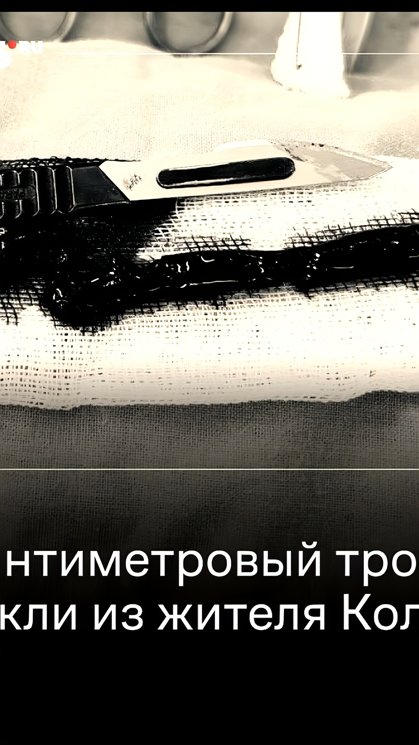 В Коломенской больнице успешно удален 50-сантиметровый тромб у 64-летнего пациента