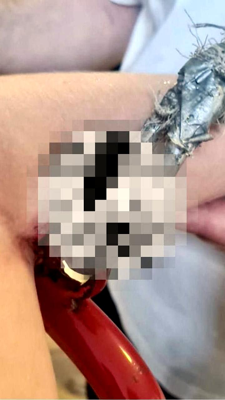 10-летний мальчик получил травму на детской площадке в Подмосковье, успешно прооперирован