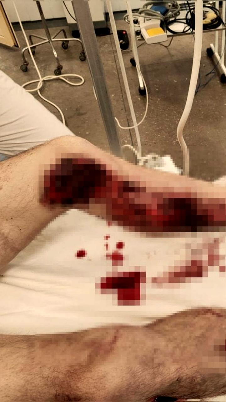 Врачи Екатеринбурга и Орла успешно спасли мужчин с тяжелыми травмами