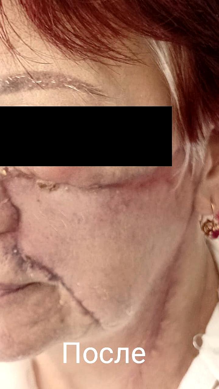 Ставропольские хирурги успешно удалили гигантскую родинку у 68-летней пациентки
