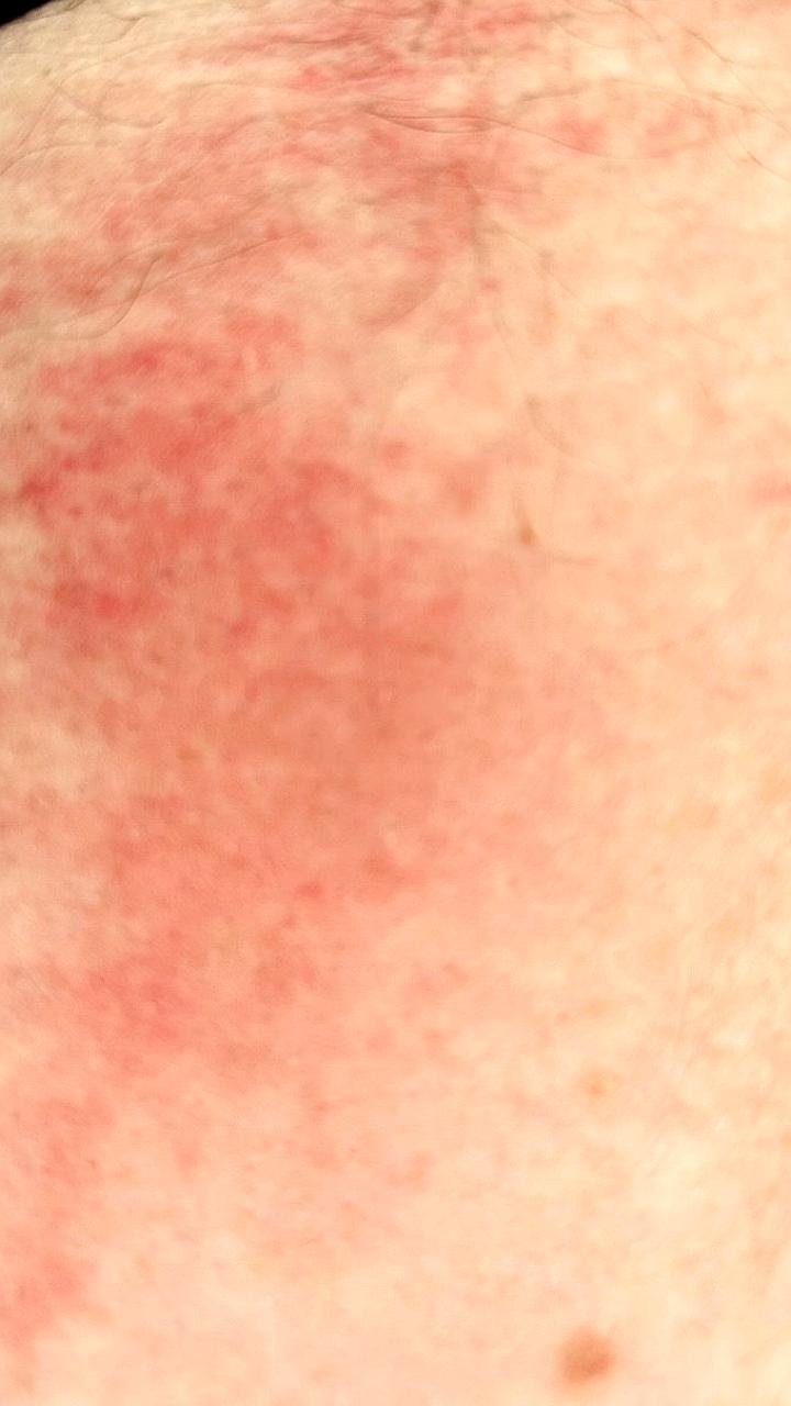Серия контактов с медузами-крестовиками на Русском острове во Владивостоке