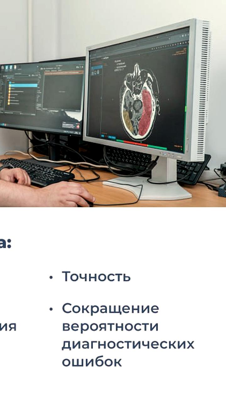 В Москве тестируют ИИ-систему для диагностики инсульта и хирургического лечения