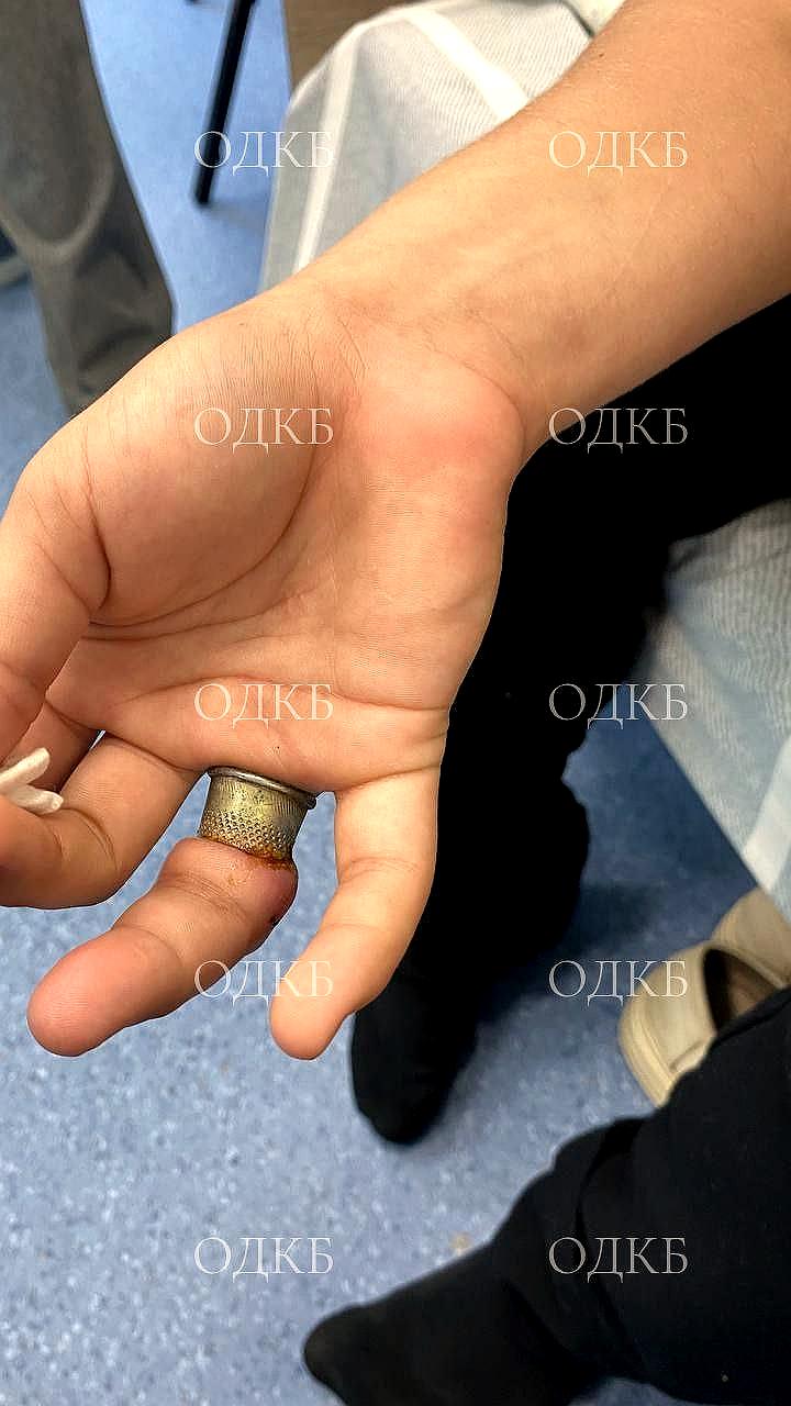 Врачи спасли палец 12-летней девочки из Оренбурга после неудачного эксперимента с кольцом