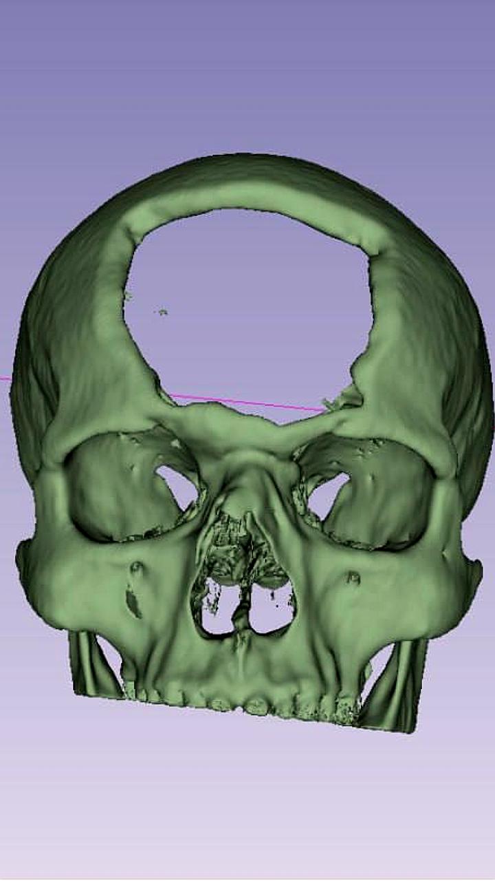 Врачи РКБ в Казани успешно восстановили череп бойца с помощью 3D печати