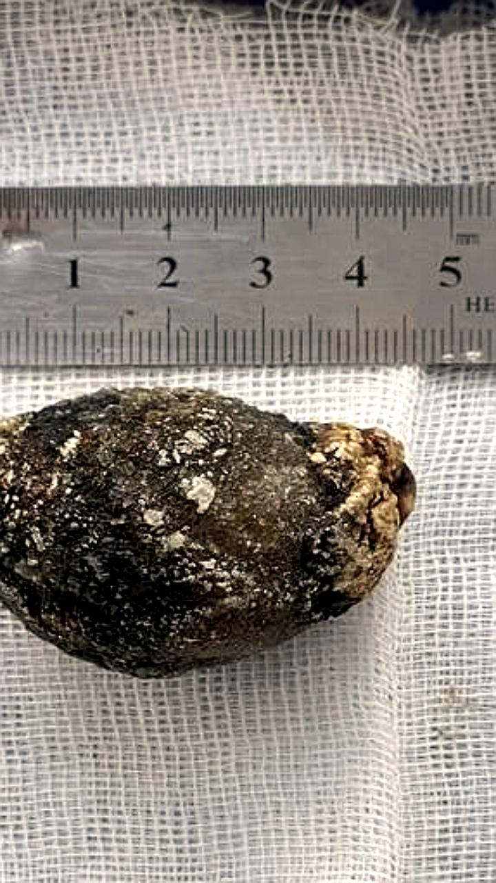 В Бурятии успешно удален желчный камень из двенадцатиперстной кишки