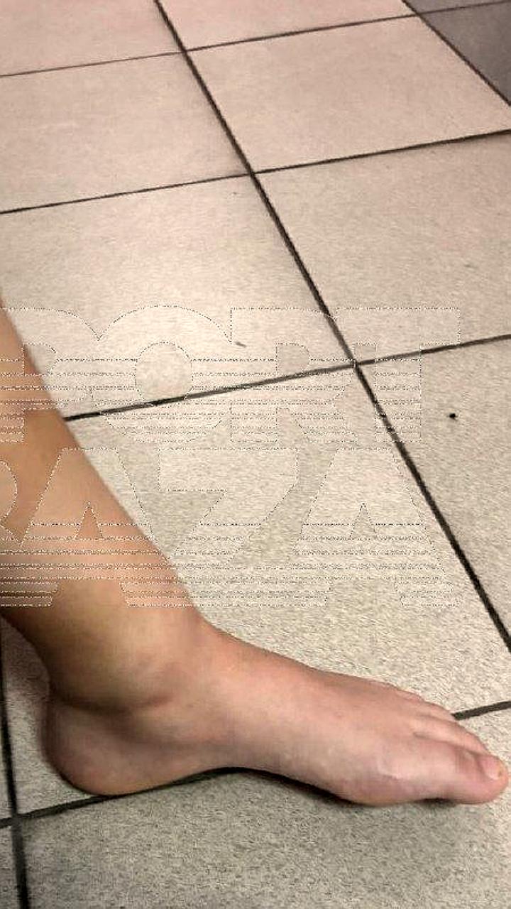Врачи ДРКБ успешно лечат 10-летнюю девочку со столбняком после травмы