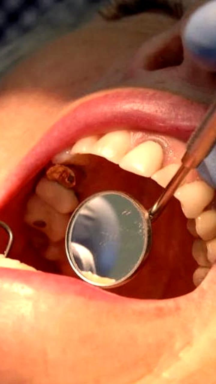 Ученые из Ноттингемского университета разработали гель для восстановления зубной эмали