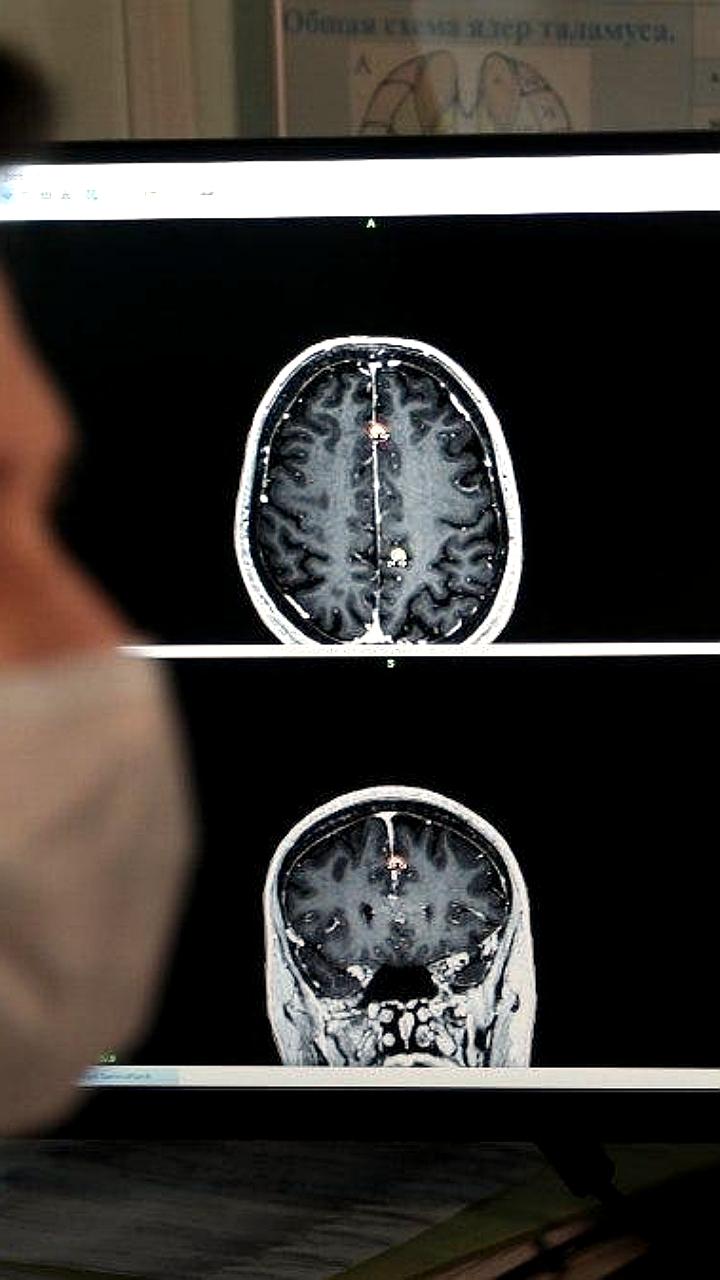 ТГУ представил ИИ для ранней диагностики болезни Альцгеймера в рамках международного сотрудничества