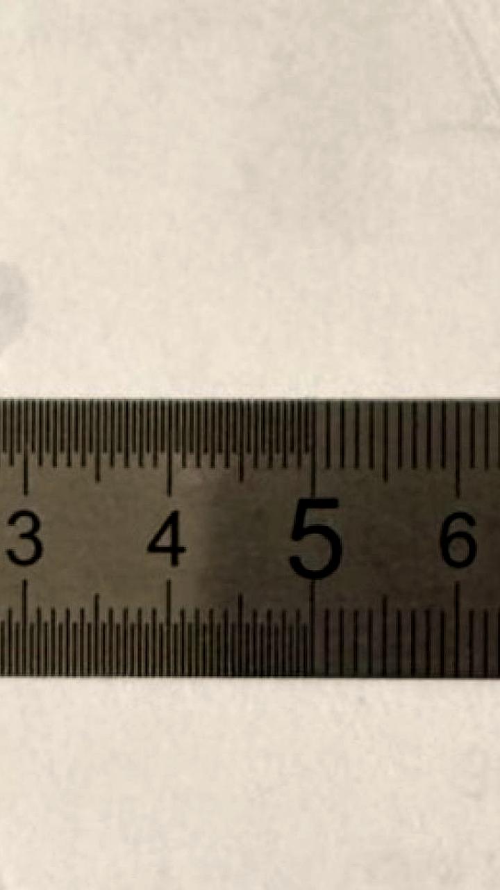 Врачи извлекли колпачок от ручки из легких 13-летнего подростка в Нижнем Новгороде