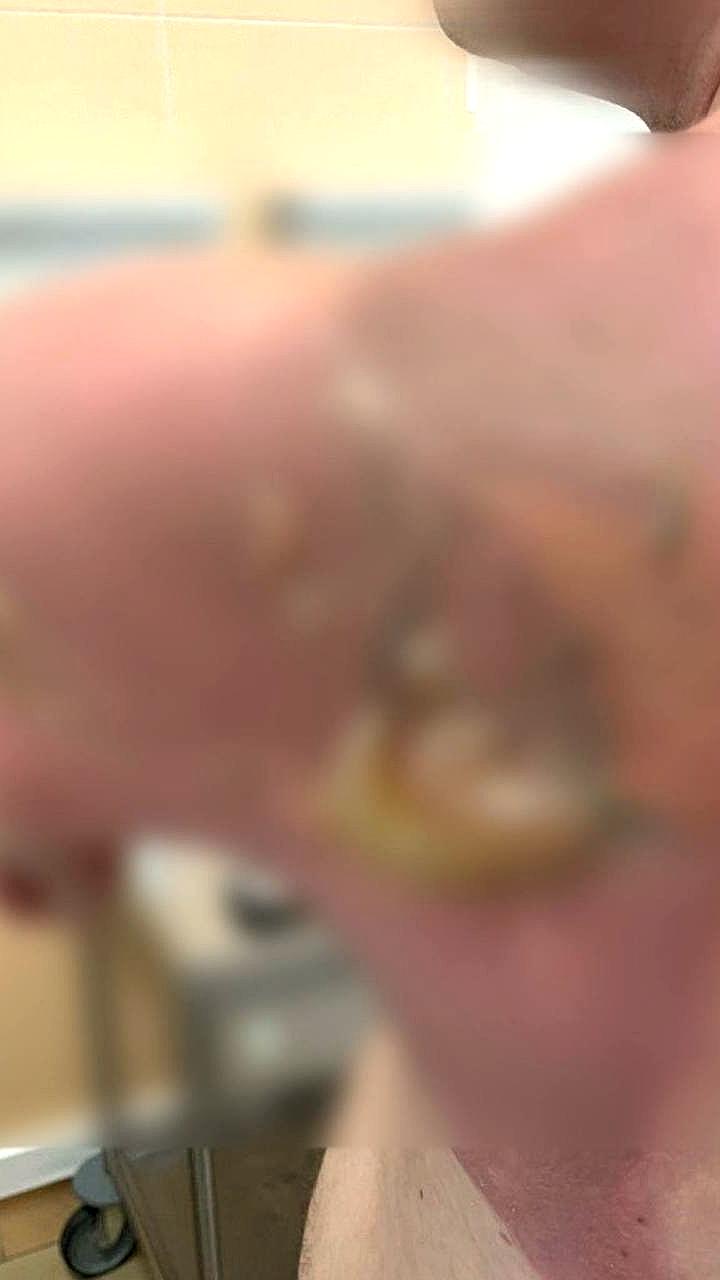 Мужчина из Татарстана получил химический ожог после стирки белья с капсулами из Азии