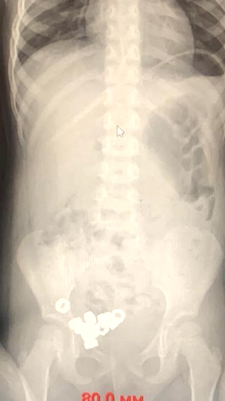 В Воронеже трехлетний ребенок успешно избавился от 16 проглоченных гаек