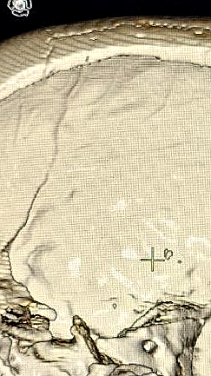 Иркутские хирурги успешно провели эндоскопическую операцию ребенку с редким заболеванием