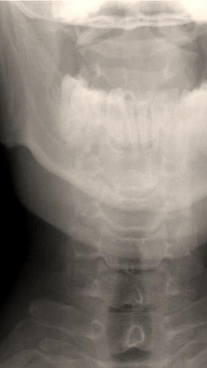 Прокуратура выявила нарушения в школе после травмы ученицы на уроке физкультуры
