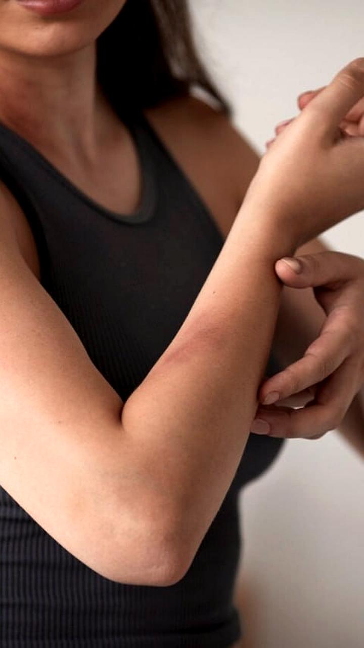 В Европе фиксируется рост случаев заражения супергрибком Trichophyton indotineae