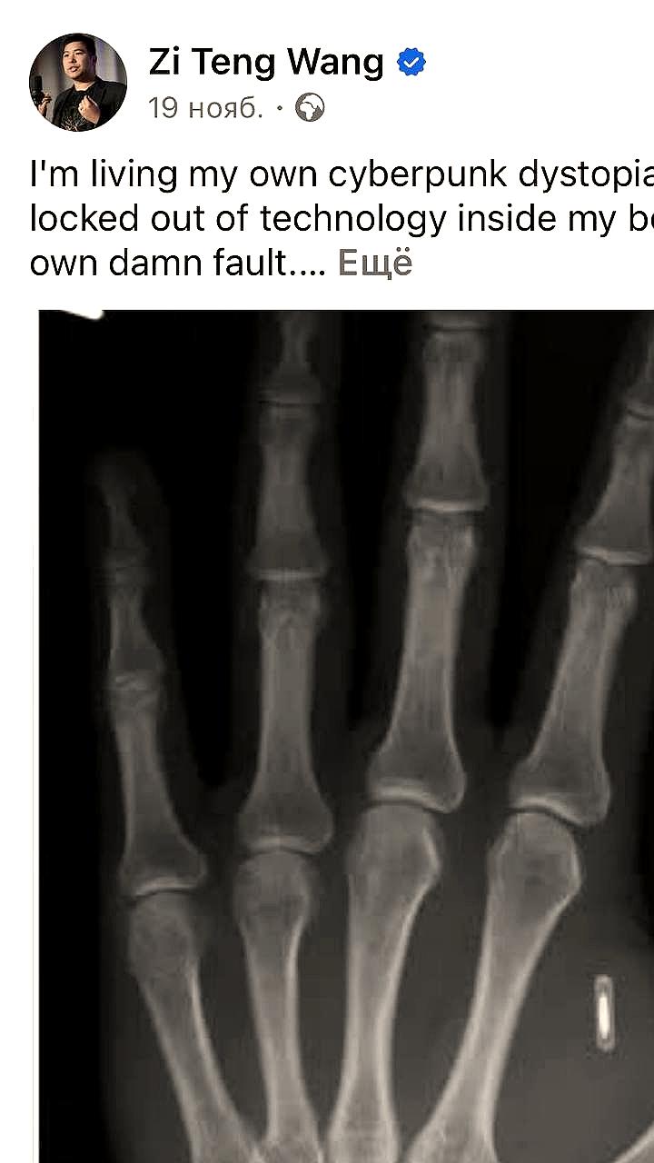 Американец забыл пароль к RFID чипу, вживленному в руку