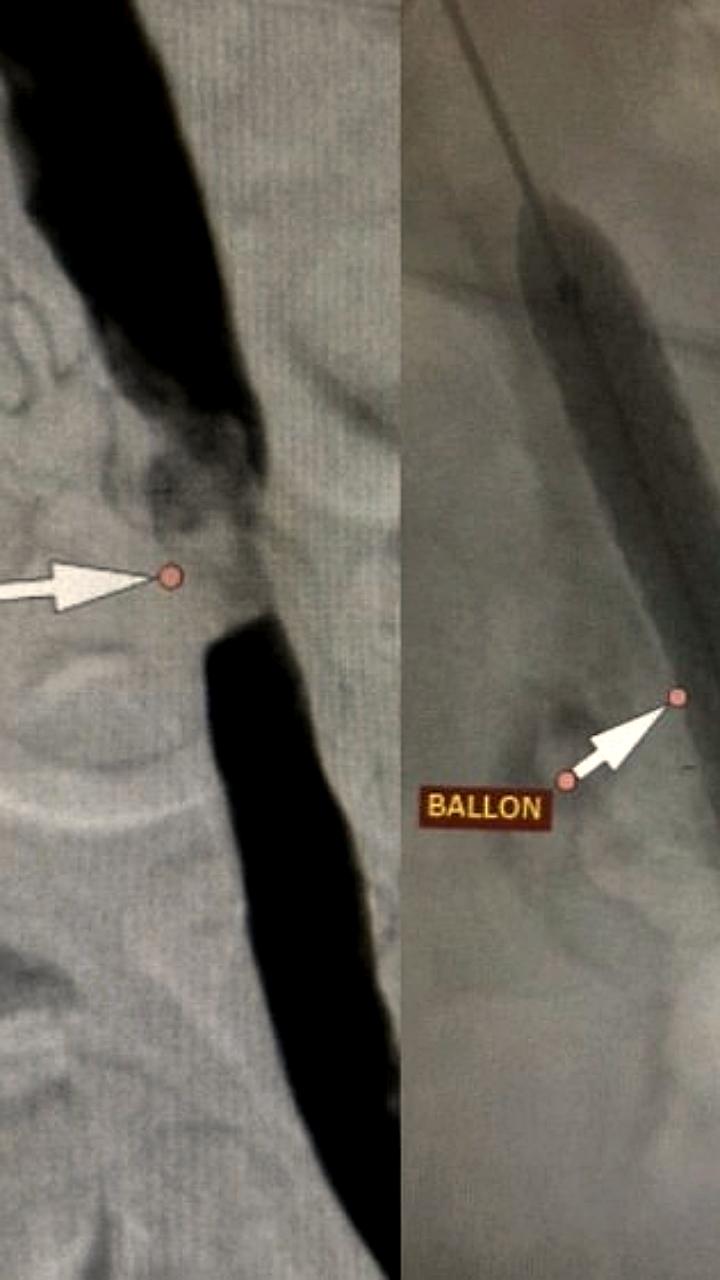 Волгоградские и казанские хирурги успешно спасли пациента от ампутации ноги