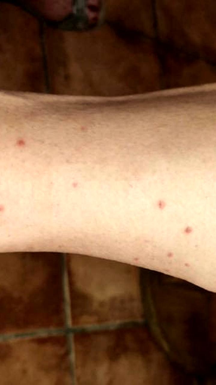 Эпидемия клопов в элитных отелях Египта вызывает массовые жалобы туристов