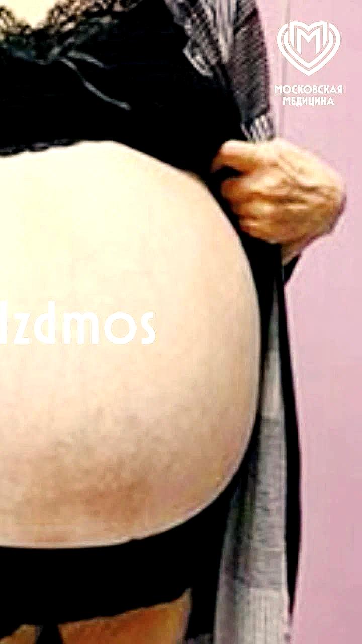 Врачи удалили 30-килограммовую опухоль у москвички после 15 лет игнорирования симптомов